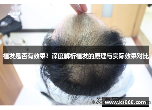 植发是否有效果？深度解析植发的原理与实际效果对比